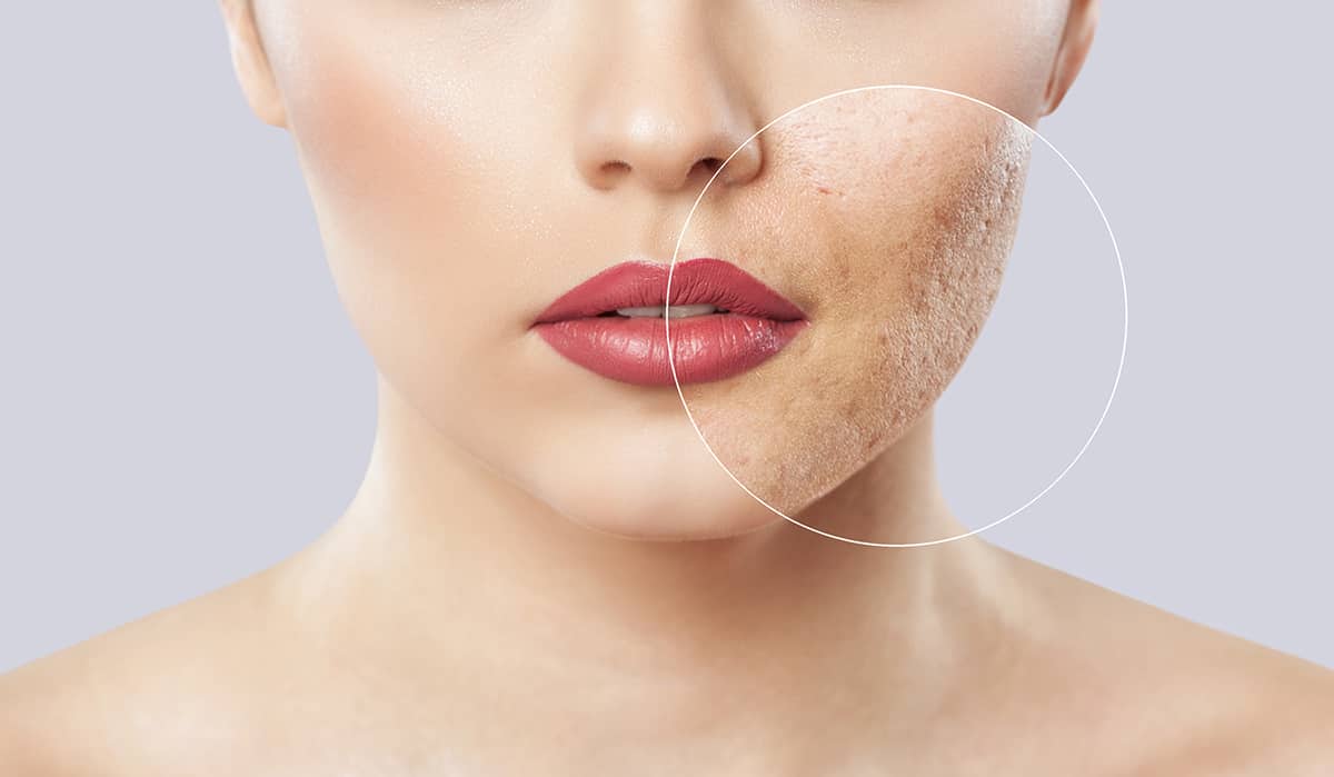 Transform Your Skin with Laser Skin Resurfacing: Everything You Need to Know